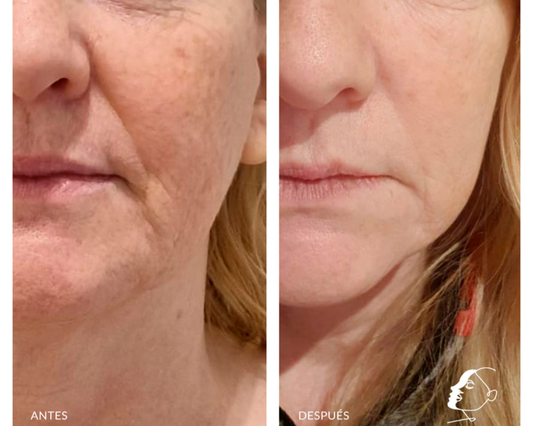 🔹 HIFU Contorno Facial