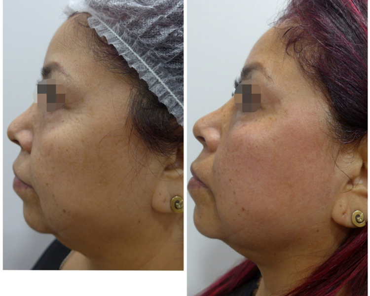 🔹 HIFU Rostro Completo (No incluye cuello ni papada)