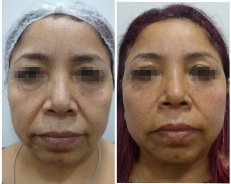 🔹 HIFU Rostro Completo (No incluye cuello ni papada)