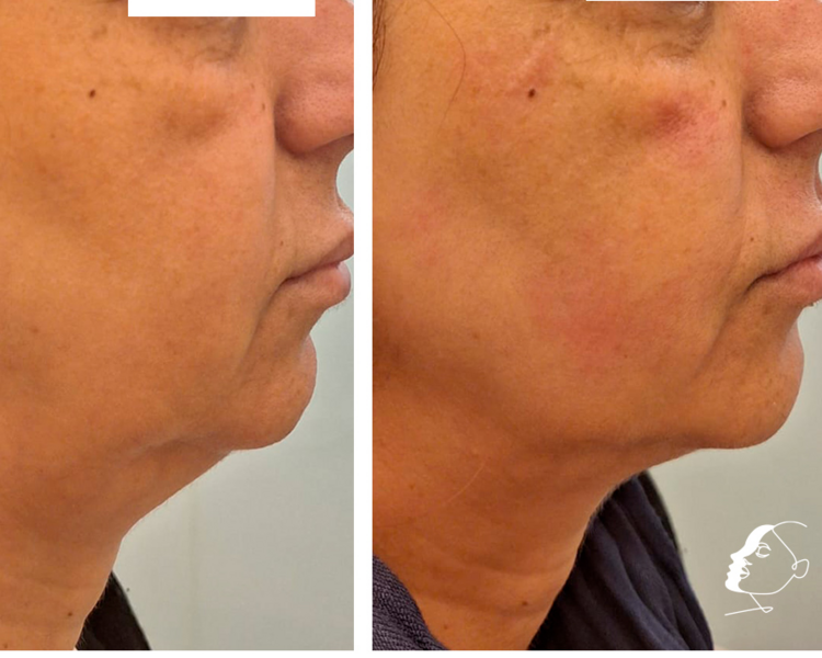 🔹 HIFU Cuello + Papada