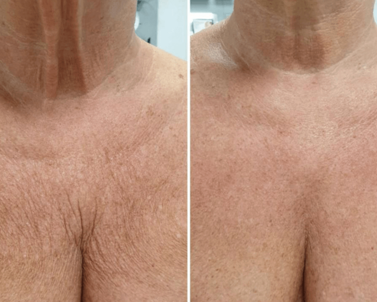 🔹 HIFU Rostro Completo + Cuello + Papada + Escote