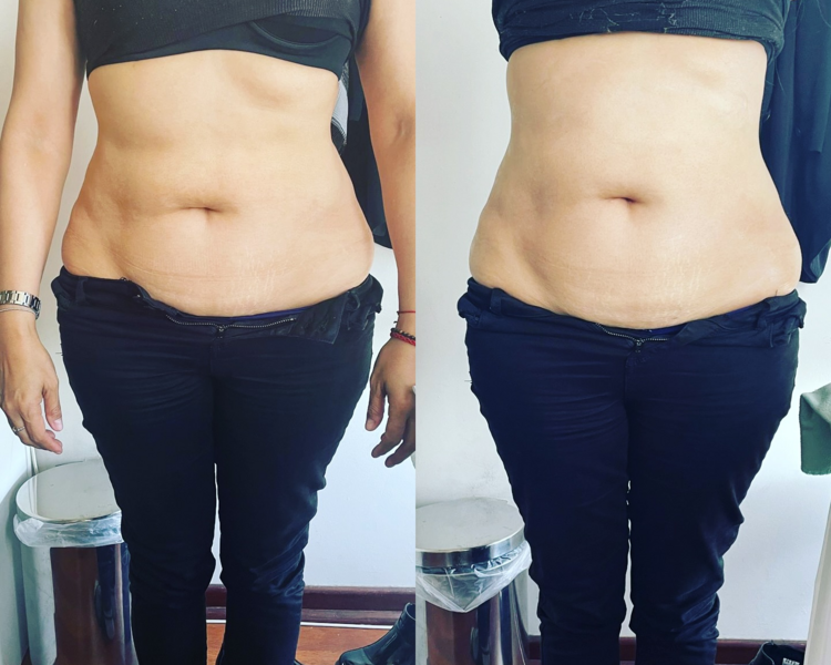 🔹 HIFU Abdomen