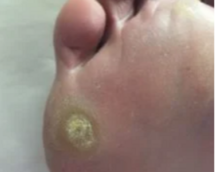 Callos plantares con bisturi