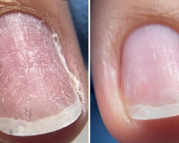 Manicura clínica preventiva