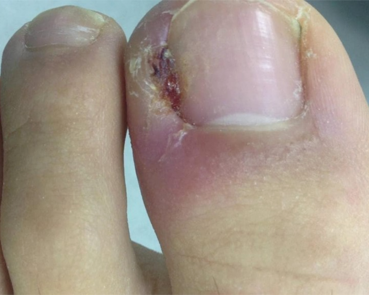 Uña incarnada unilateral