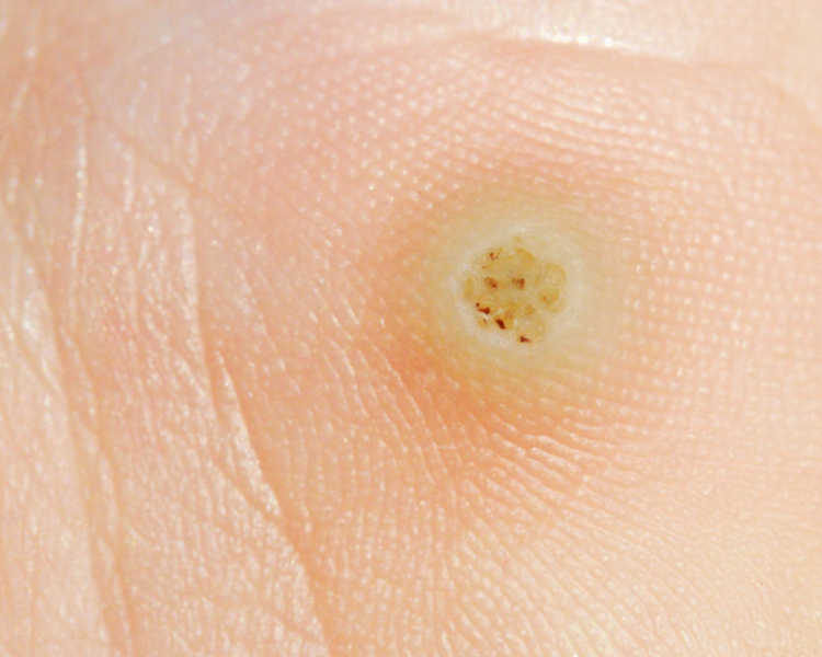 Verrugas plantares por sesión 