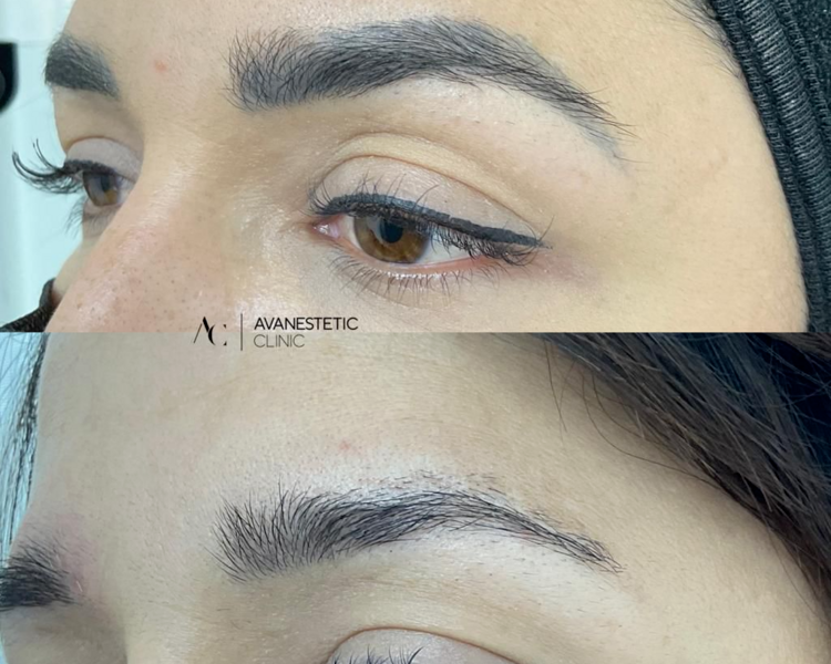 Borrado Microblading 3 sesiones