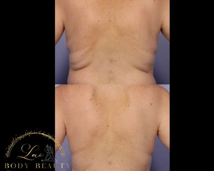 Reductivo de Espalda 