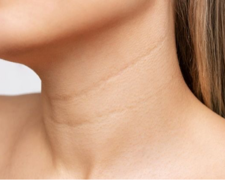 Despigmentación cuello