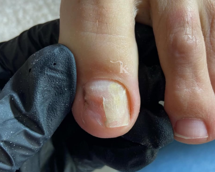 Esmaltado Semipermanente en Pies + Reconstrucción uñas 