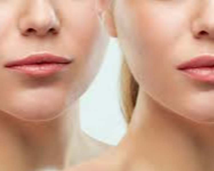 RELLENO DE LABIOS