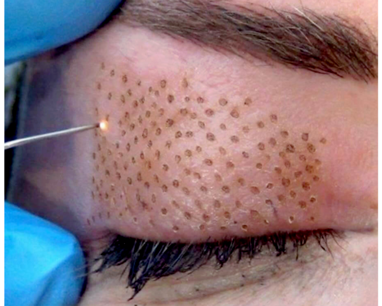 Jato de Plasma Facial