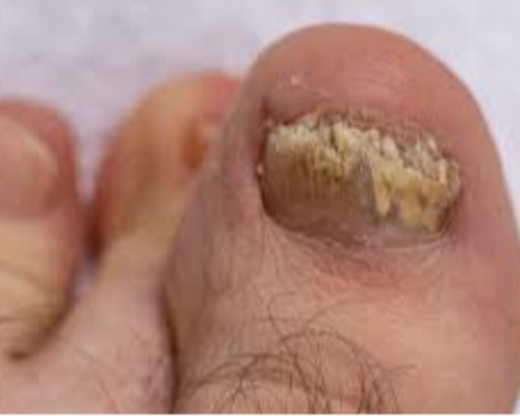 Onicomicosis