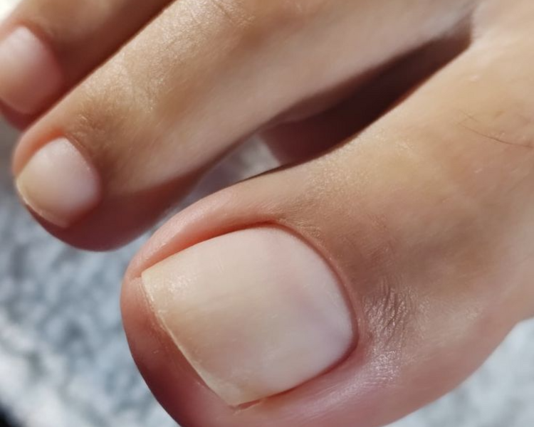 Retiro de acrilico en ambos dedos hayux (los 2 dedos gorditos de los pies)