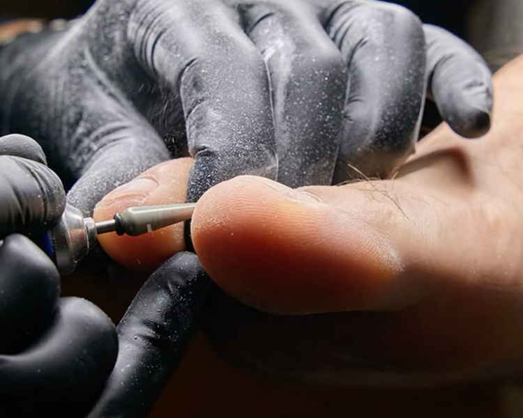 Retiro de Gel en Pies (sin nueva aplicación)