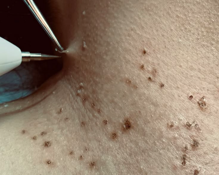 CAUTERIZACIÓN DE QUISTES EPIDÉRMICOS Y VERRRUGAS 