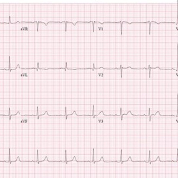 Electrocardiograma con informe