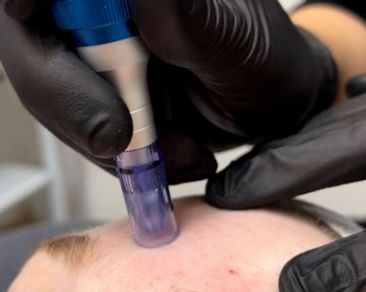 Dermapen