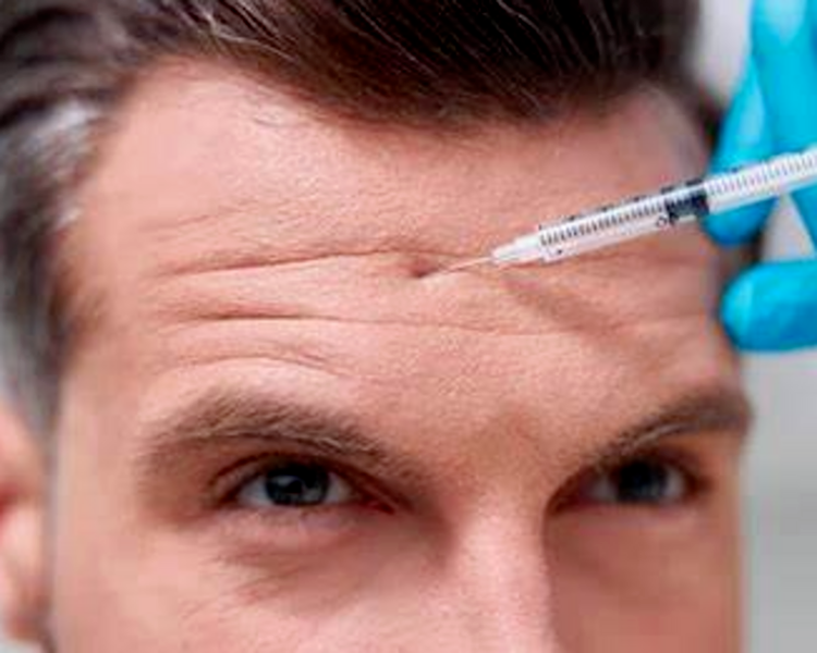 💉 Toxina Botulínica Médica – Arrugas Faciales Tercio Superior (Frente, entrecejo y patas de gallo)