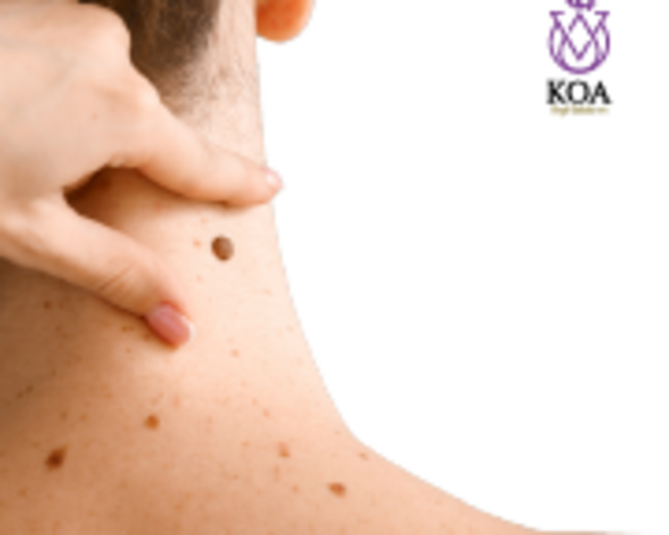 VALORACION LUNARES Y VERRUGAS