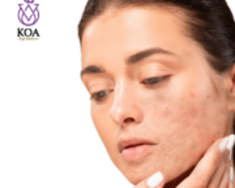 VALORACION CICATRICES DE ACNÉ