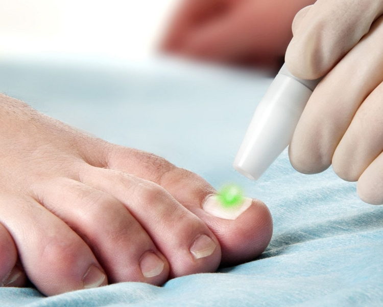 Evaluación Onicomicosis Laser 