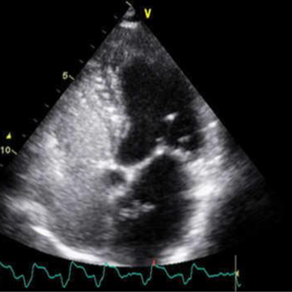 Ecocardiograma doppler con Test de burbujas