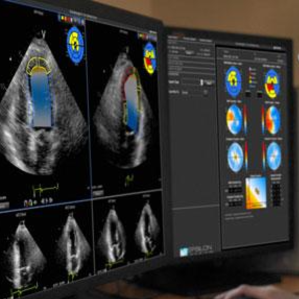 Ecocardiograma de estrés con dobutamina