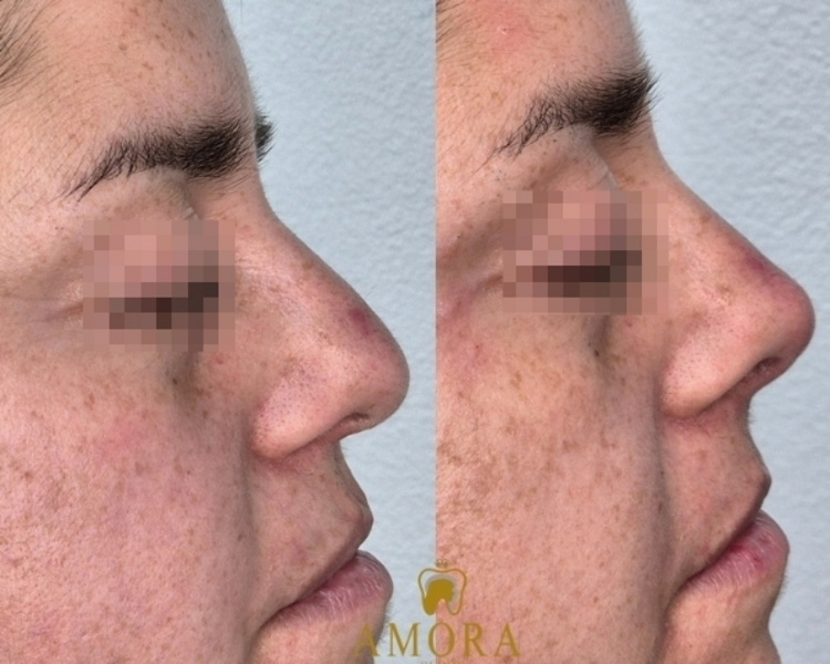 Rinomodelación –$180.000 (M. Hyafilia) / $260.000 (M. Juvederm)