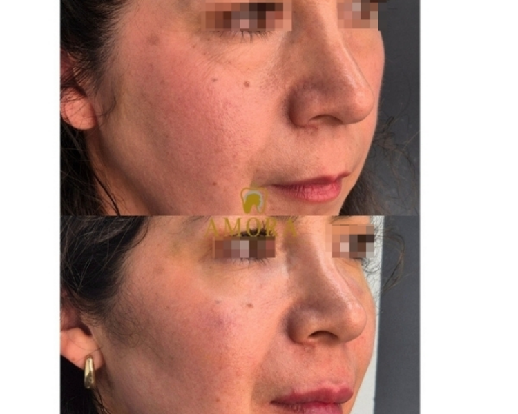 Aumento de pómulos – $200.000 (M. Hyafilia) / $280.000 (M.Juvederm)