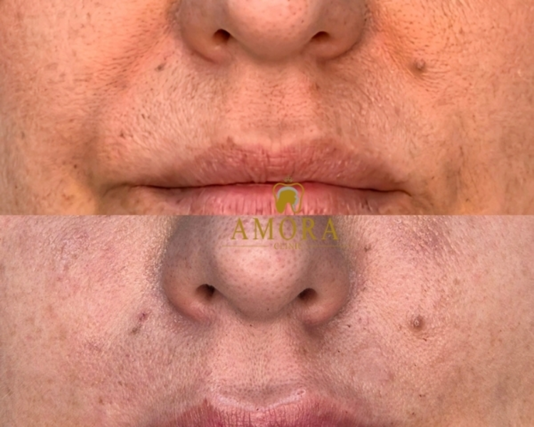Relleno de surcos nasogenianos –$200.000 (M. Hyafilia)/ $280.000 (M. Juvederm)