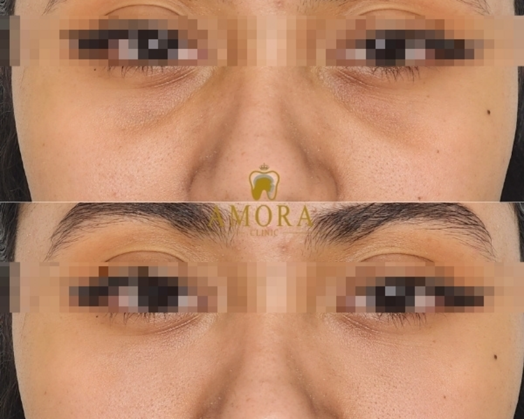 Relleno de ojeras  – $200.000 (M. Hyafilia) /$280.000 (M. Juvederm)