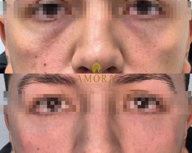 Reposición de mejillas– $200.000 (M. Hyafilia)/ $280.000 (M. Juvederm)