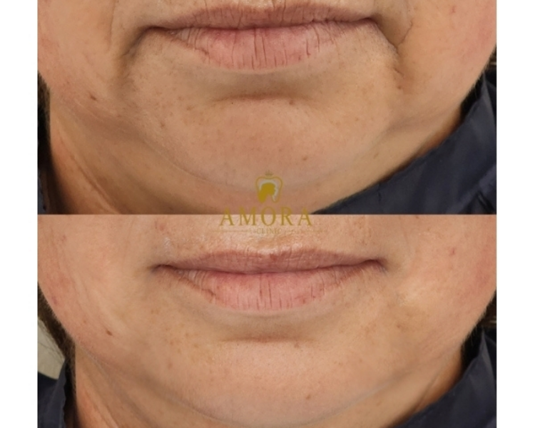 Relleno de líneas de marioneta– $200.000 (M. Hyafilia) /$280.000 (M. Juvederm)