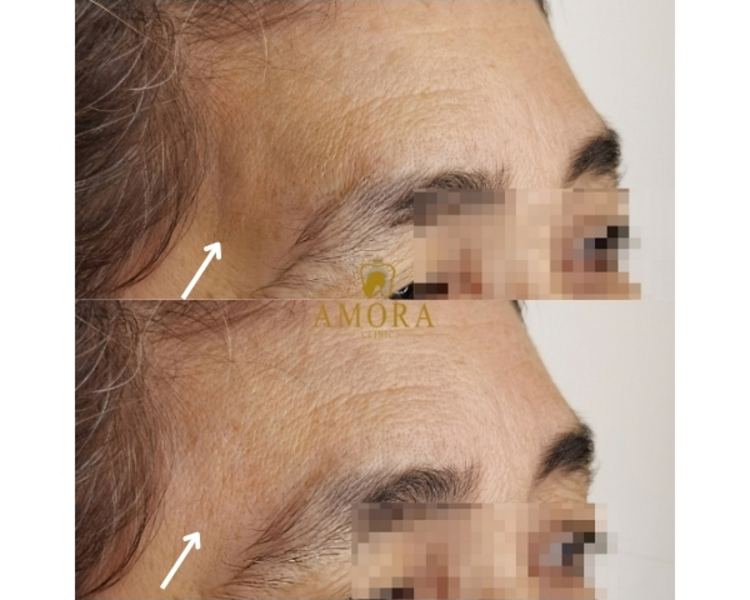 Relleno de zona temporal– $200.000 (M. Hyafilia) /$280.000 (M.Juvederm)