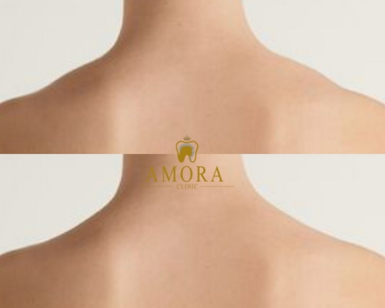 Trap box- Cuello de barbie