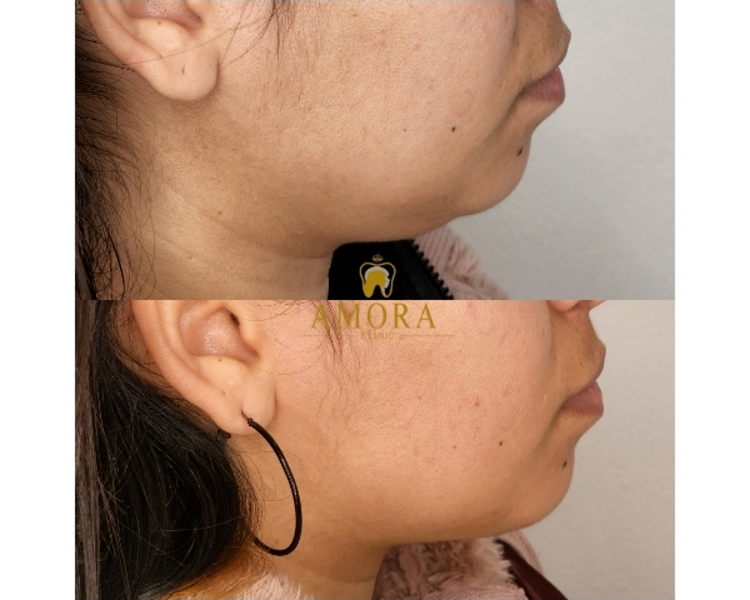 Lipopapada enzimática (Pack 3 sesiones)