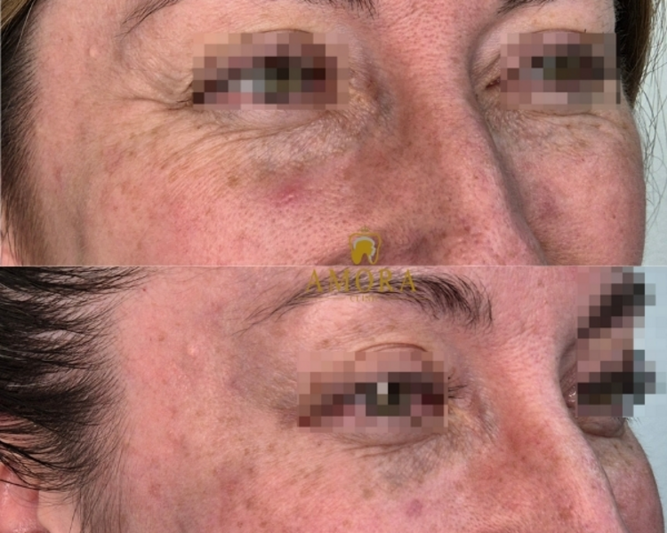  Bótox Tercio superior(Entrecejo, frente, P.gallo):  1 zona :$95.000/ 2 zonas:$150.000/ 3 zonas:$180.000