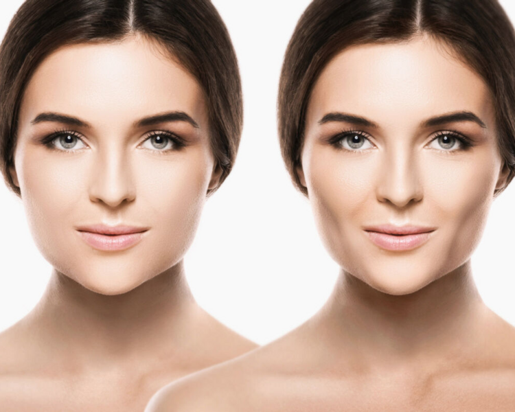 Bichectomia enzimática (pack 3 sesiones)