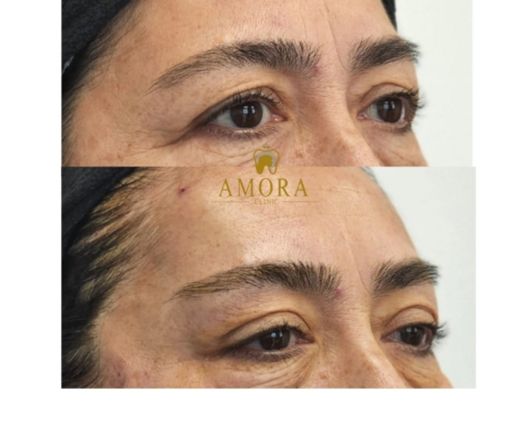 Lifting cejas (Foxy eyes)- Hilos de tracción