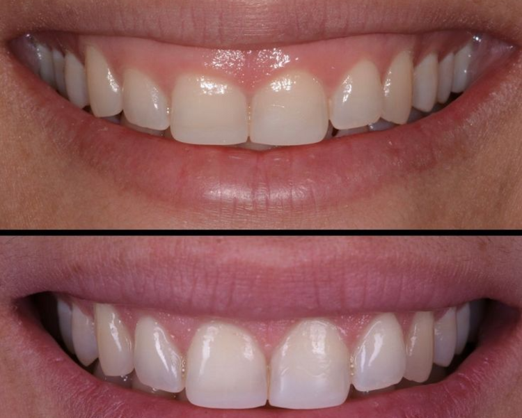 Gingivectomia quirúrgica