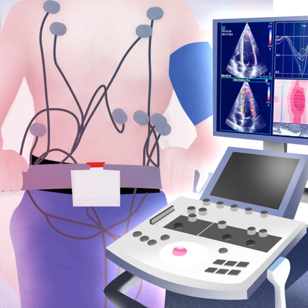 Ecocardiograma de esfuerzo (ejercicio)