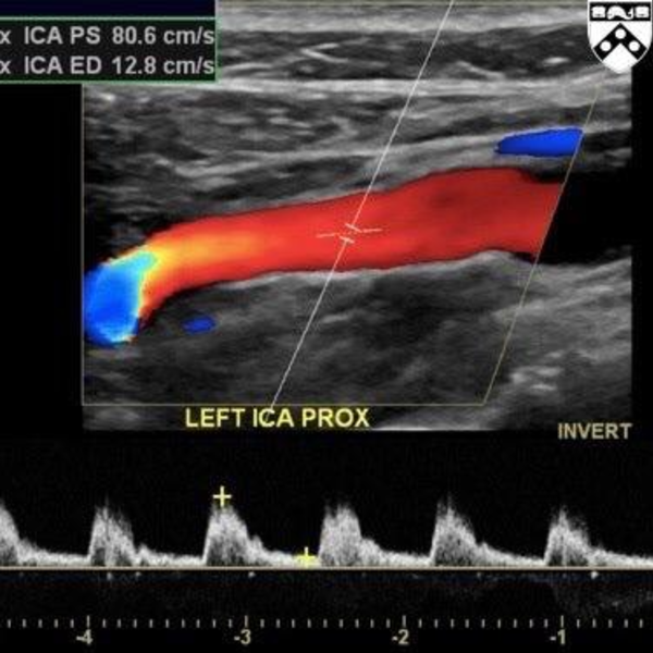 Eco doppler arterial extremidades