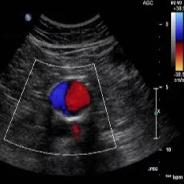 Eco doppler abdominal (aorto-ilíaco)