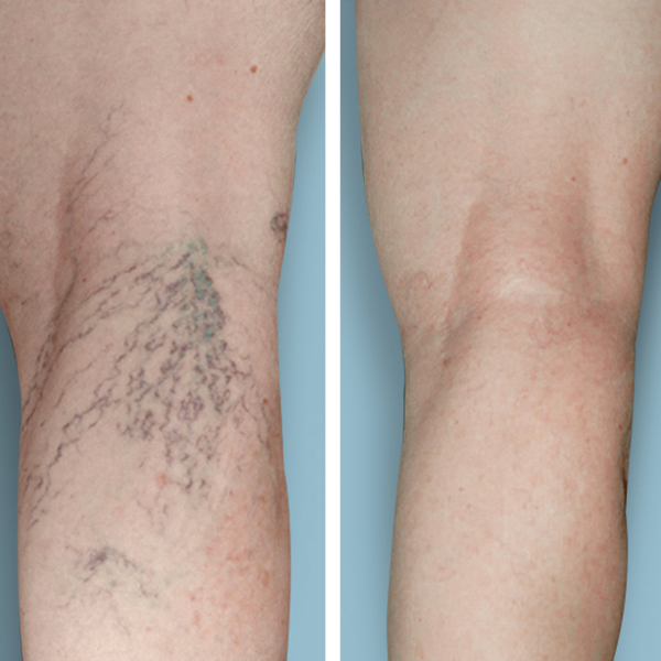Escleroterapia (1 sesión)