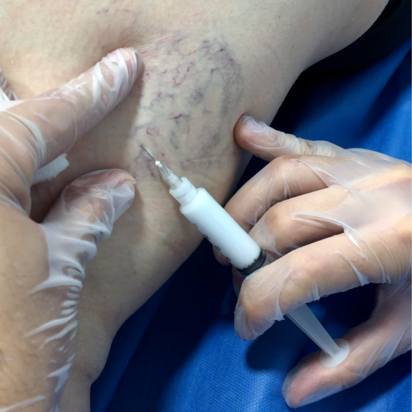 Escleroterapia (1 sesión)