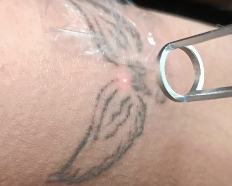 Valoración - Remoción de Tatuajes corporales