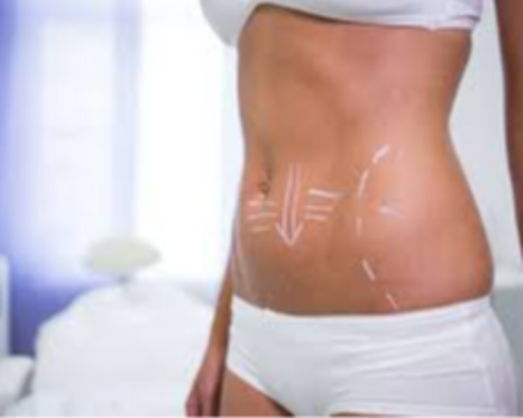 🔥 HIFU Corporal: Esculpí tu cuerpo sin cirugía 🔥 Alta intensidad, resultados visibles: Abdomen+ Flancos