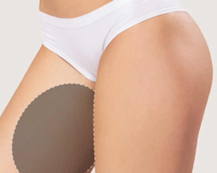 🔥 HIFU Corporal: Esculpí tu cuerpo sin cirugía 🔥 Alta intensidad, resultados visibles: Cara Interna de piernas
