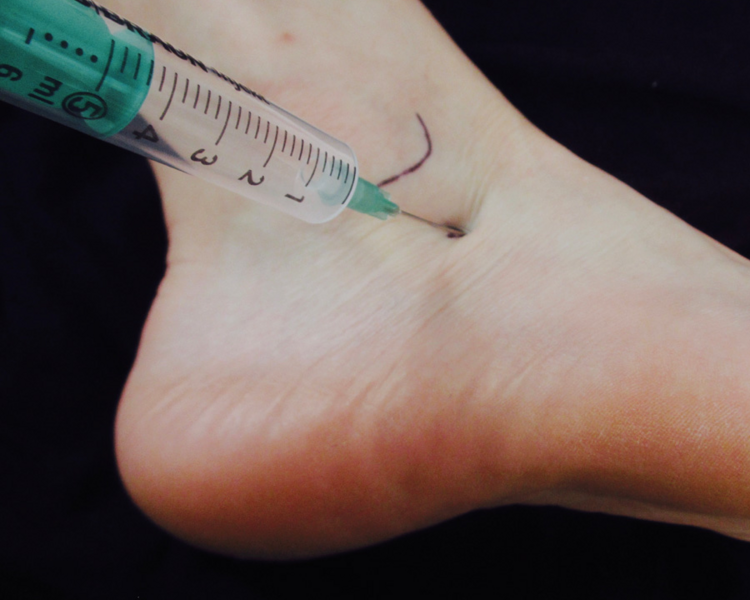 Infiltaciones Bilaterales Tobillos  / Bilateral Ankle Infiltrations ( 5 sesiones ) 